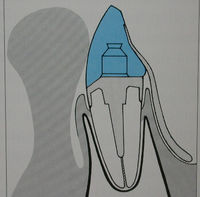 foto 21 protesi dente fissa.jpg